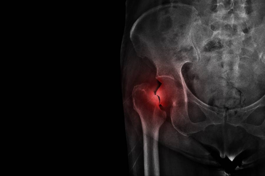 Fractured hip