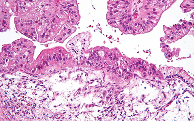 Ovarian cancer cells