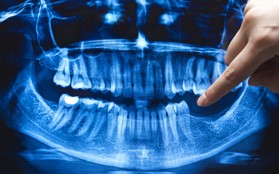Xray shows jaw and teeth